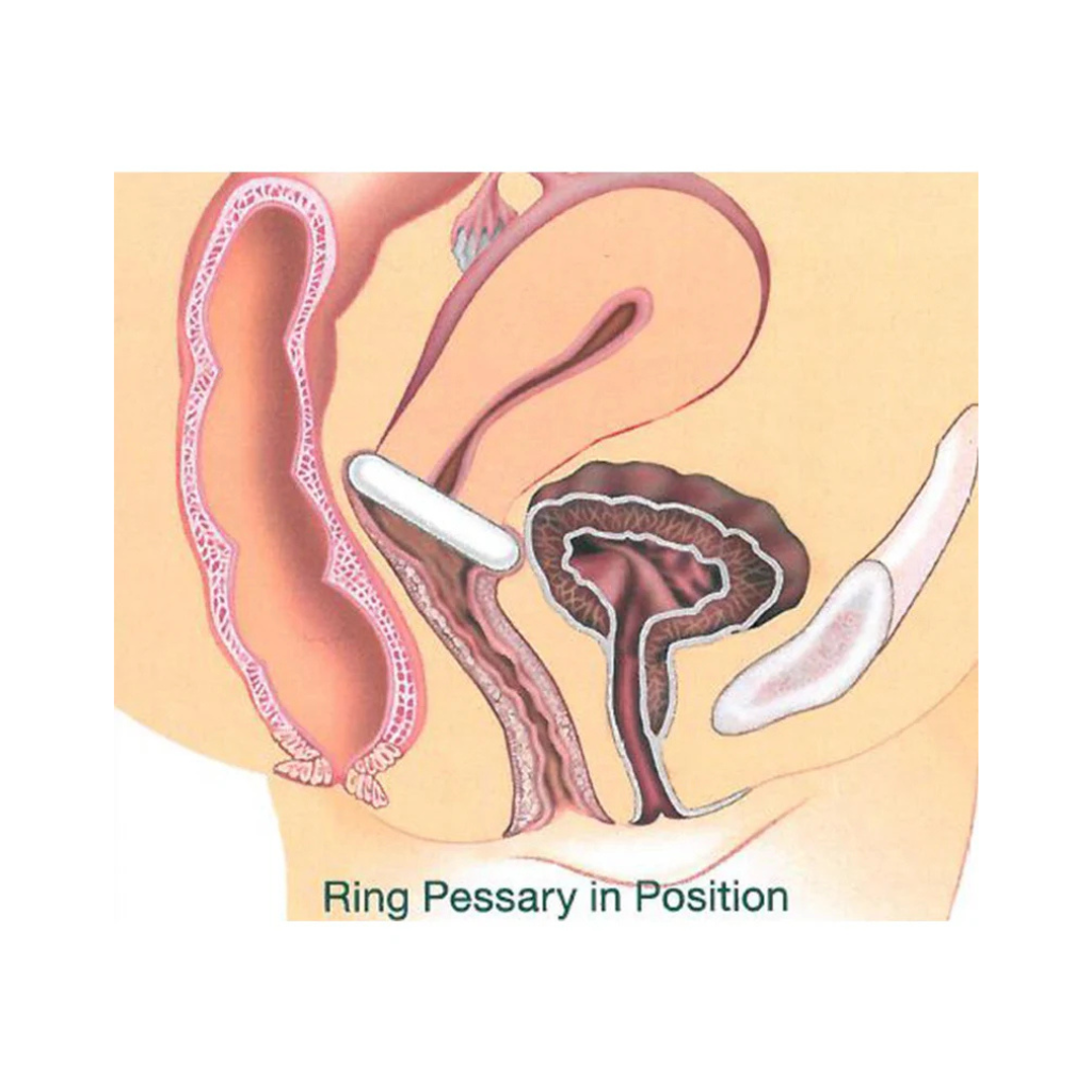 Pessaire Ring silicone Dr Arabin