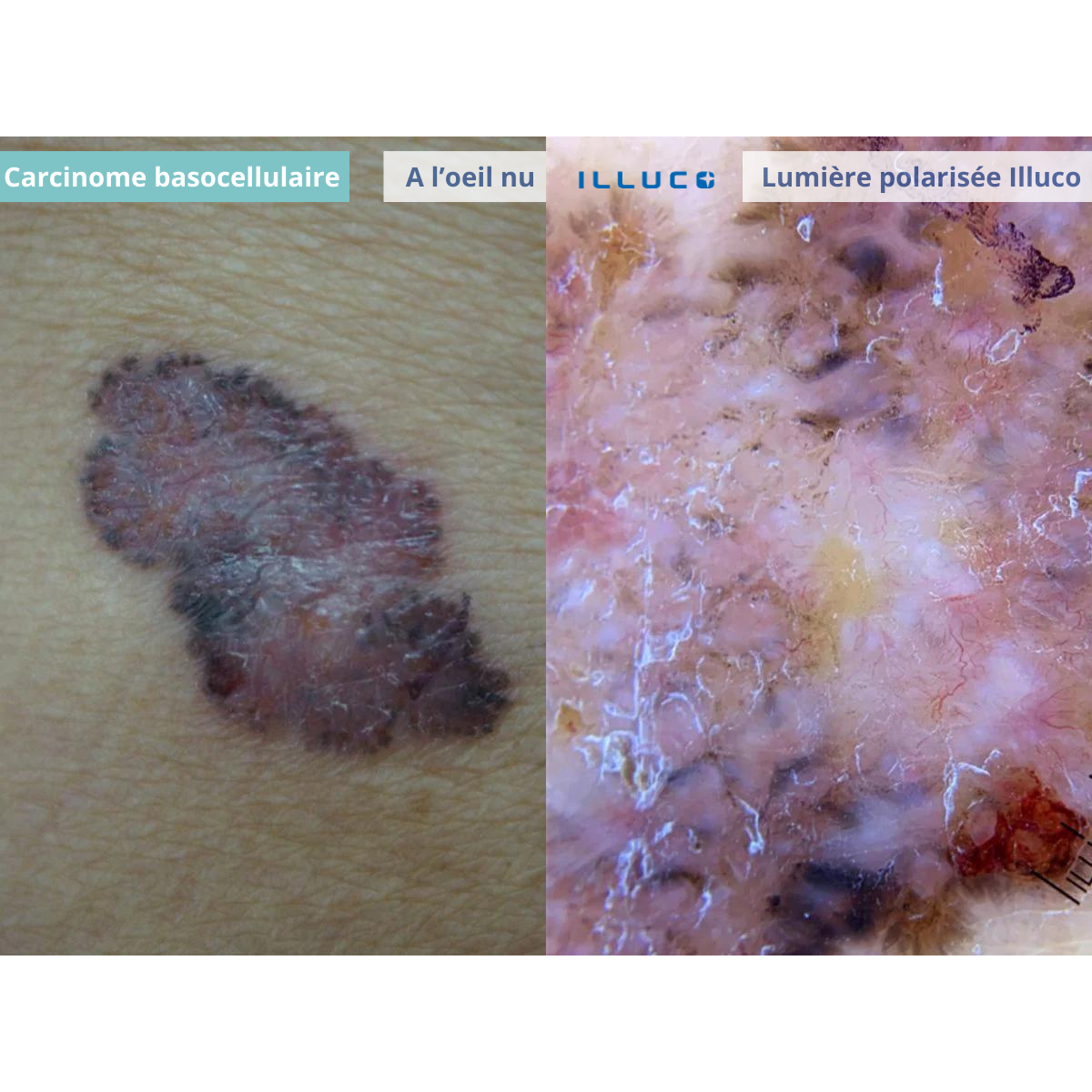 ILLUCO IDS-1100 Oplaadbare Dermatoscoop