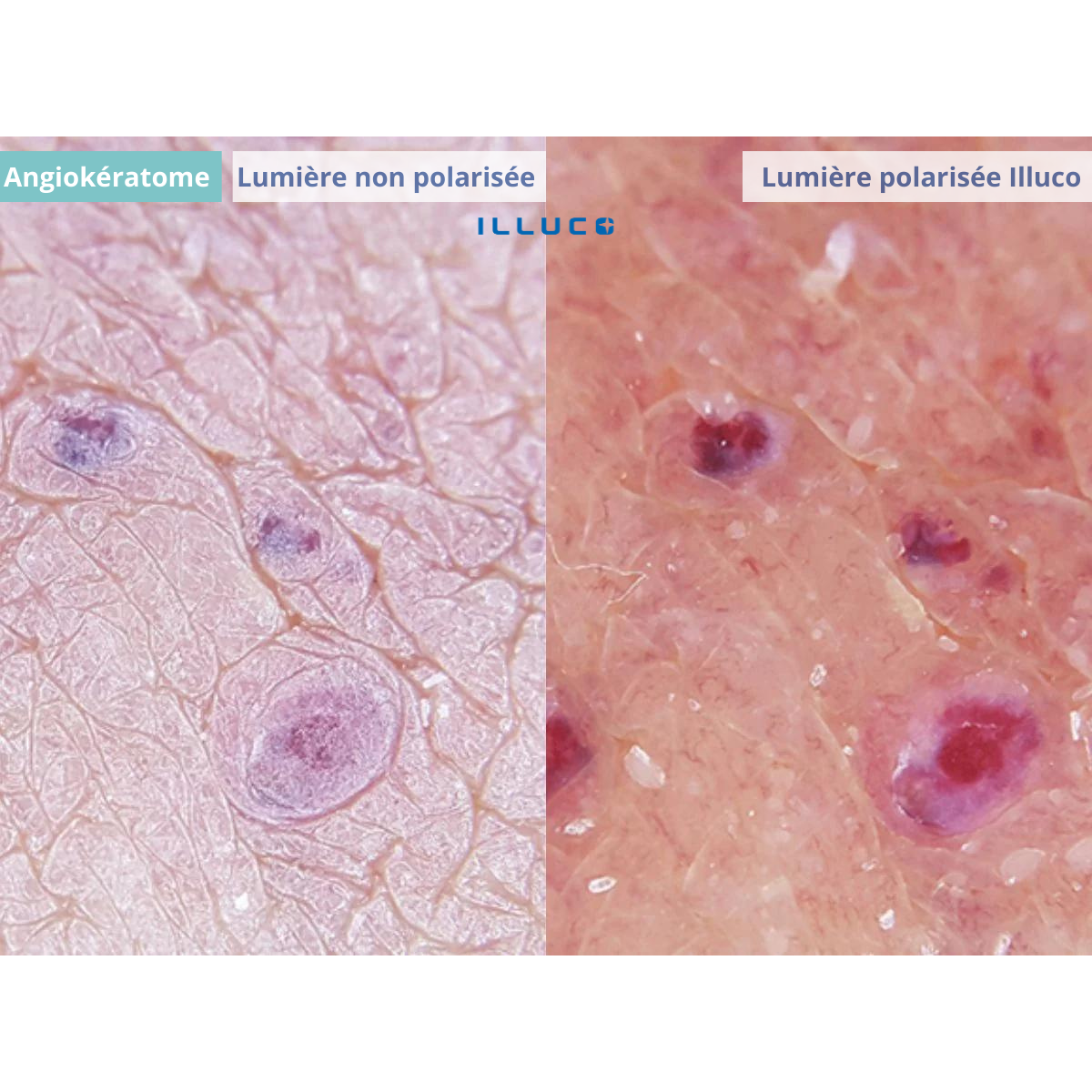 ILLUCO IDS-1100 Oplaadbare Dermatoscoop