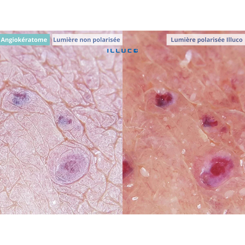 ILLUCO IDS-1100 Oplaadbare Dermatoscoop