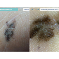ILLUCO IDS-1100 Oplaadbare Dermatoscoop
