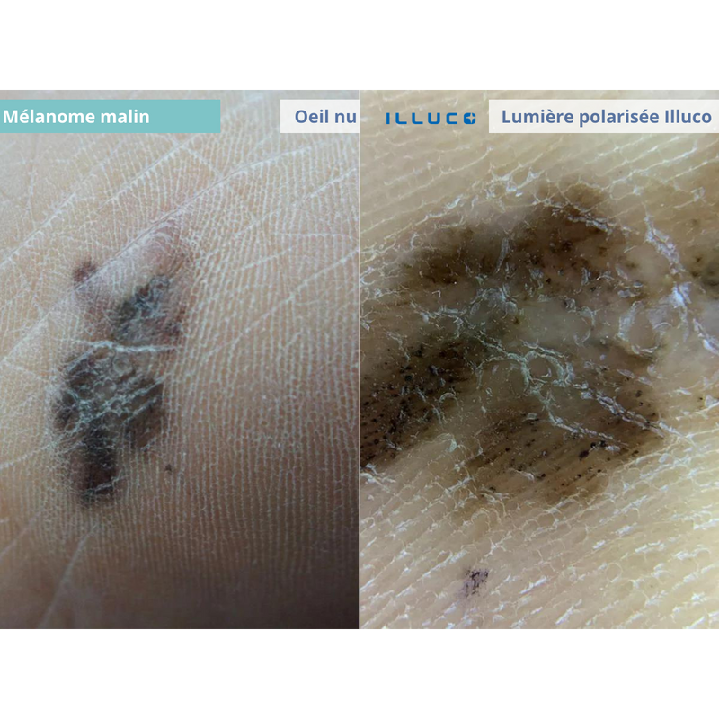 ILLUCO IDS-1100 Oplaadbare Dermatoscoop