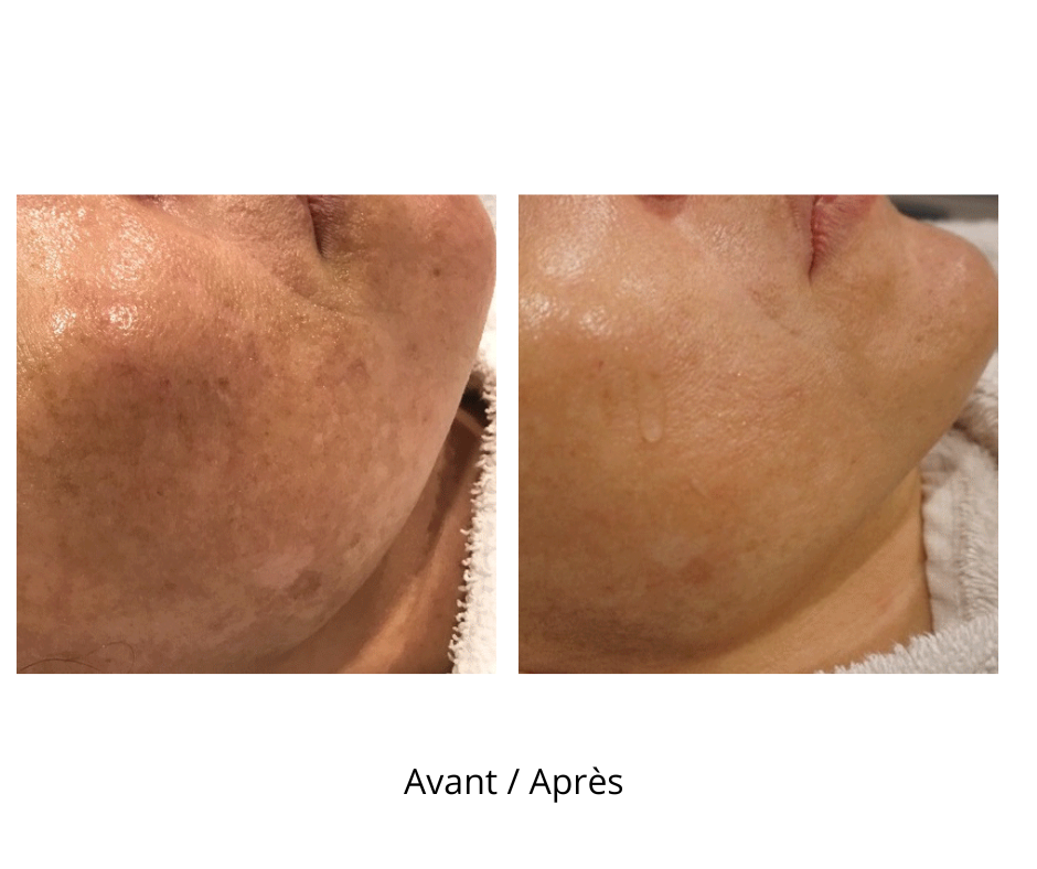 Dermaroller microneedling professionnel 9 rangées d’aiguilles avec profondeur de 1 mm