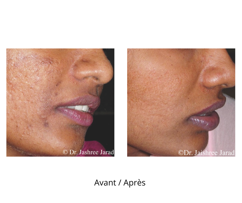 Dermaroller microneedling professionnel 9 rangées d’aiguilles avec profondeur de 1 mm