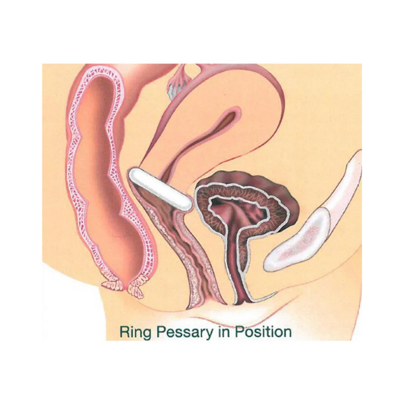 Kit Pessaire Gyn&Ring pliable complet