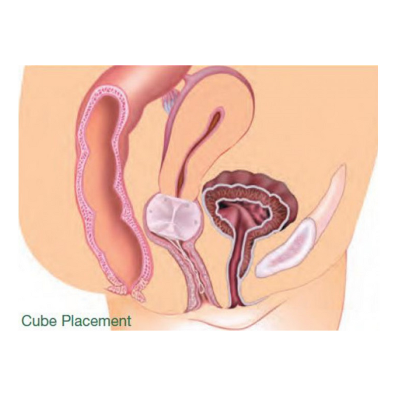 Gyn&amp;Cube siliconen pessarium - GYNEAS