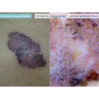 ILLUCO IDS-1100 Oplaadbare Dermatoscoop