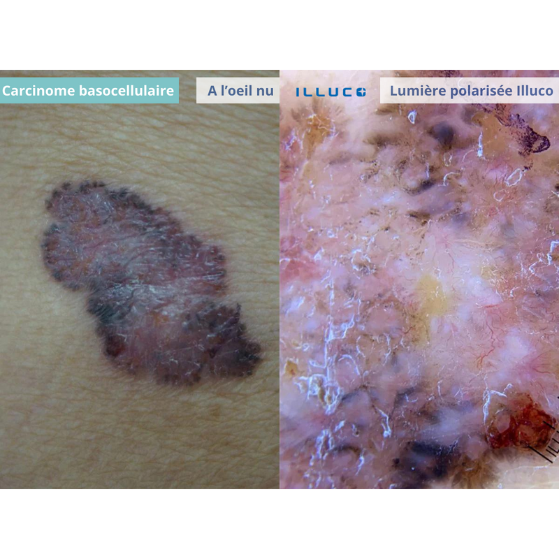 ILLUCO IDS-1100 Oplaadbare Dermatoscoop