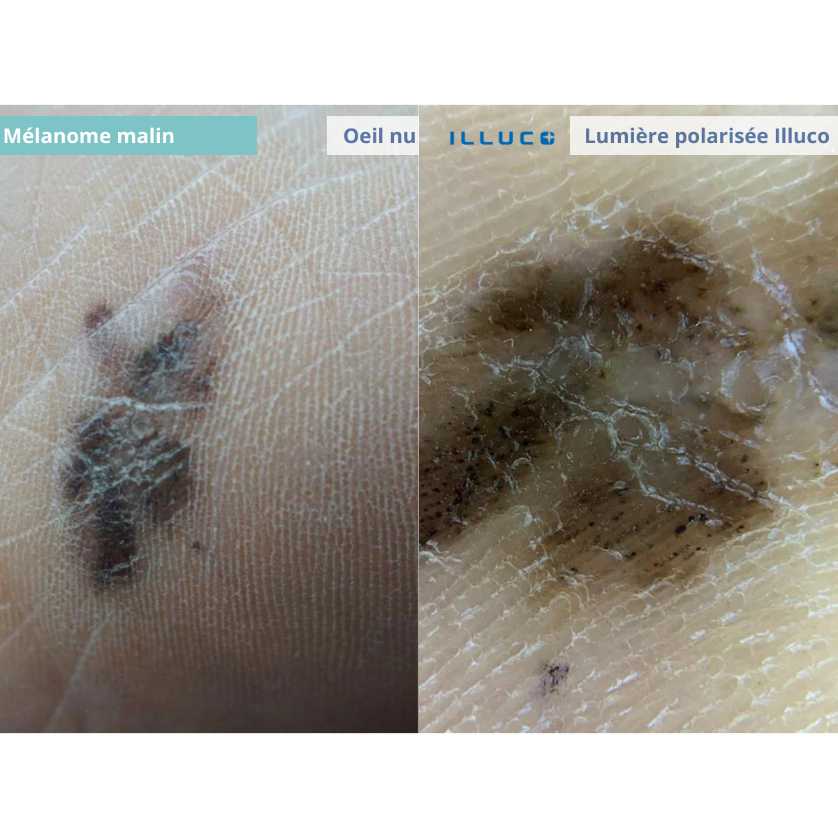 ILLUCO IDS-1100 Oplaadbare Dermatoscoop