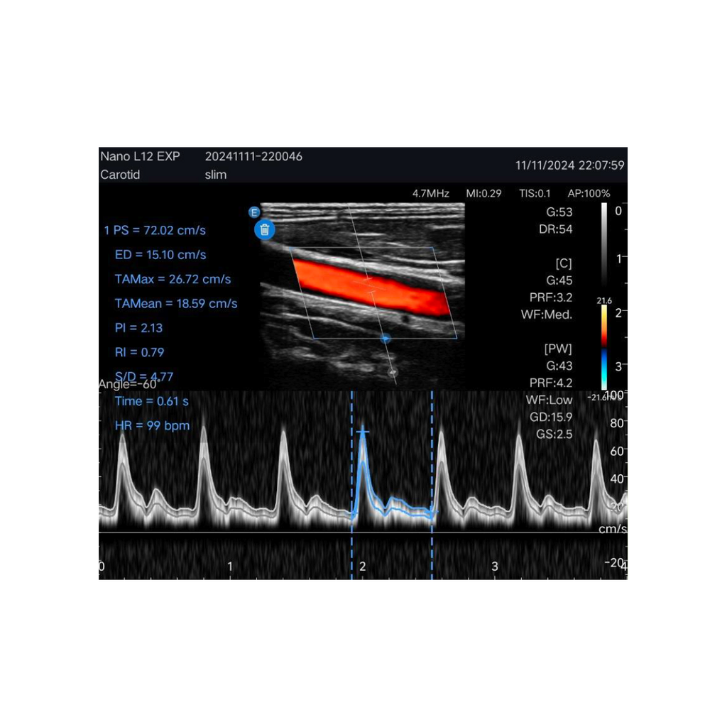 Edan Nano Lineaire Draagbare Kleuren Ultrasound Scanner