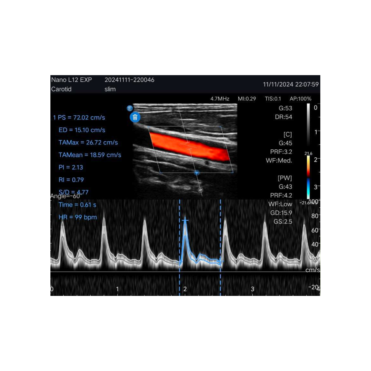 Edan Nano Lineaire Draagbare Kleuren Ultrasound Scanner